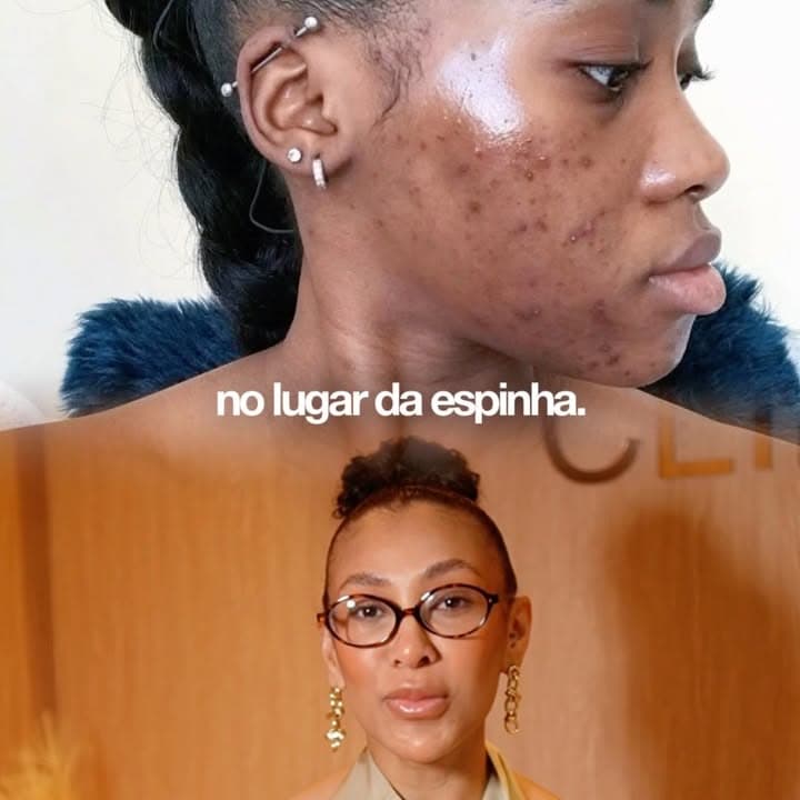 Método Clean Skin para acne em pele negra