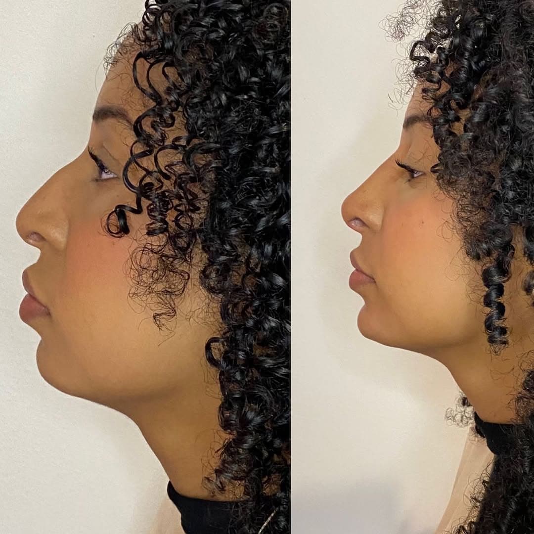 Antes e depois de perfiloplastia: nariz e queixo mais harmônicos, traços preservados