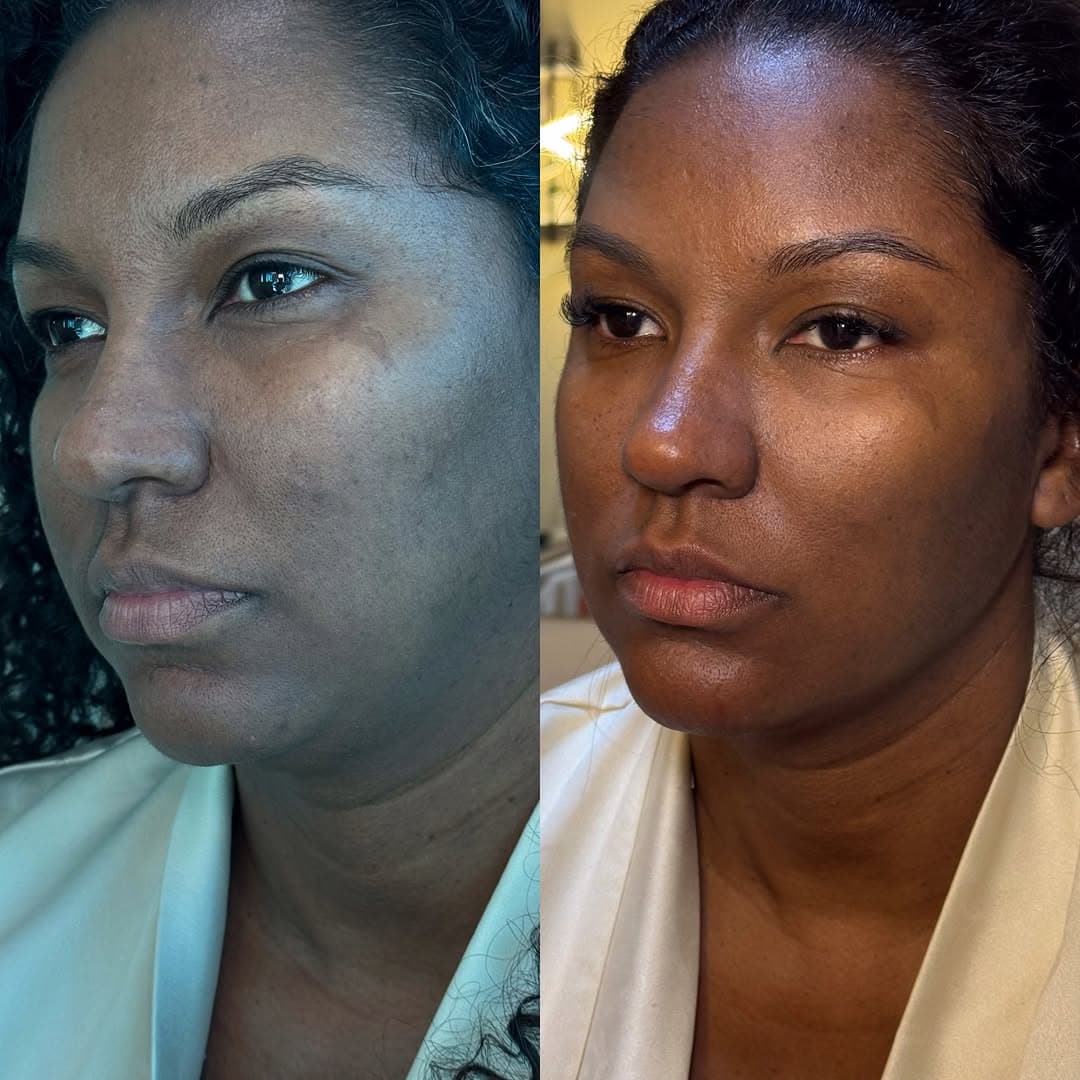 Antes e depois de tratamento de pele negra: olheiras suavizadas e luminosidade